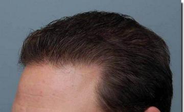 Hair restoration procedure results