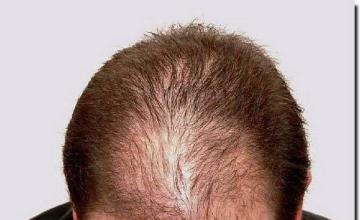 Hair restoration procedure results