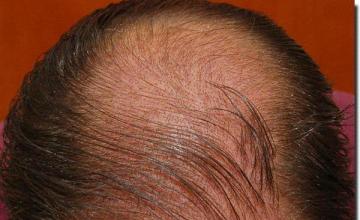 Hair restoration procedure results