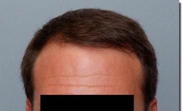 Hair restoration procedure results
