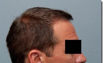 Hair restoration procedure results