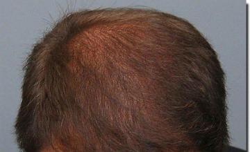 Hair restoration procedure results