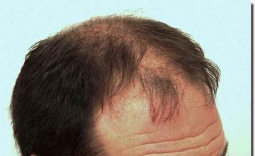 Hair restoration procedure results