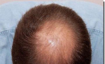 Hair restoration procedure results