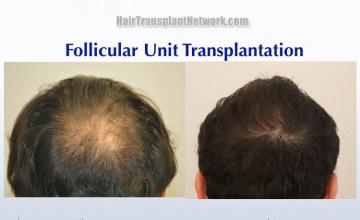 Hair transplantation surgery before and after photos