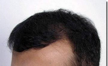 Hair restoration procedure results