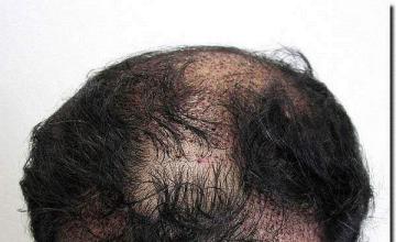 Hair restoration procedure results