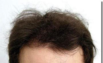 Hair restoration procedure results