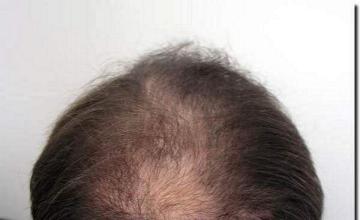 Hair restoration procedure results