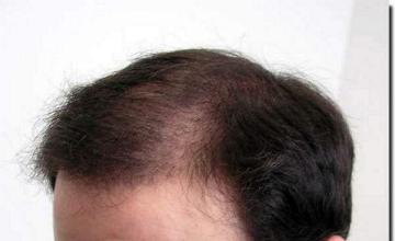 Hair restoration procedure results