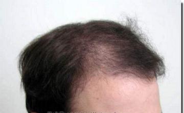 Hair restoration procedure results