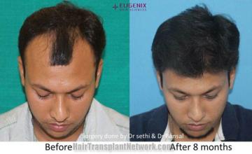 Before and after FUE hair restoration procedure images