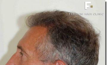 Hair restoration procedure results