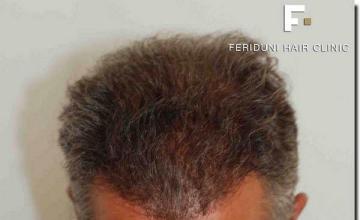 Hair restoration procedure results