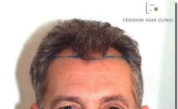 Hair restoration procedure results