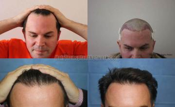 Hair restoration procedure before and after results