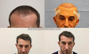 Hair restoration procedure before and after results