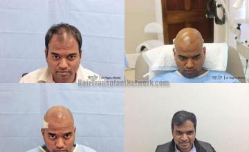 Hair restoration procedure before and after results