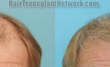 Hair transplantation surgery before and after images