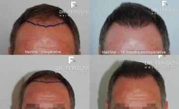 Hair restoration procedure before and after results