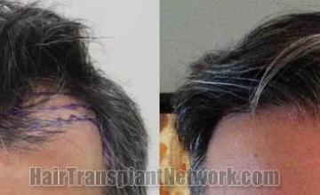 Hair restoration procedure before and after results