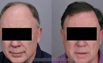 Hair restoration procedure before and after results