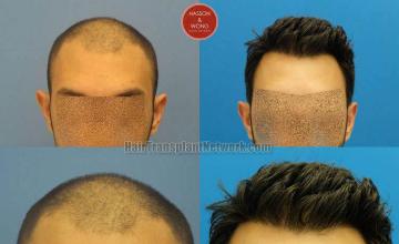 Hair restoration procedure before and after results