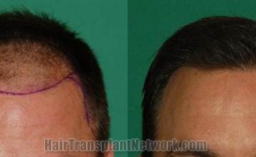 Hair restoration procedure before and after results