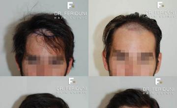 Hair restoration procedure before and after results