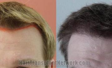 Hair restoration procedure before and after results