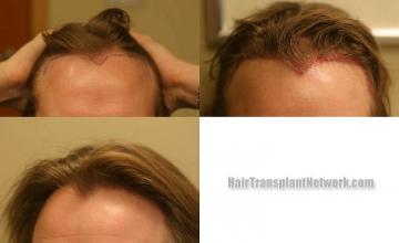 Hair transplantation surgery before and after images