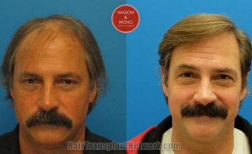 Hair restoration procedure before and after results