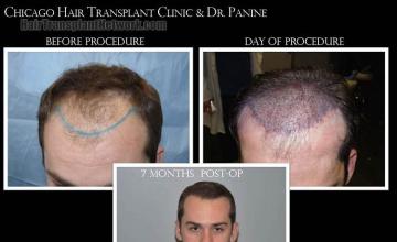 Hair restoration procedure before and after results