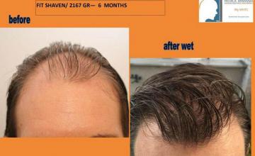 Hair restoration procedure before and after results