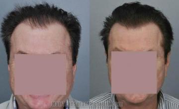 Hair restoration procedure before and after results