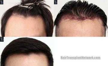 Hair restoration procedure before and after results