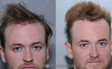 Surgical hair transplantation result photographs