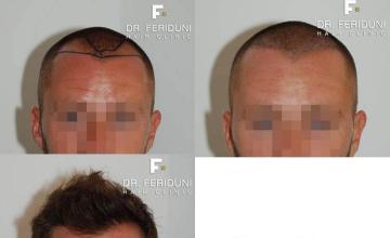 Hair transplantation surgery before and after images