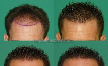 Hair transplantation surgery before and after images