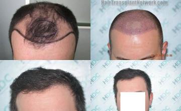 Before and after hair restoration procedure images