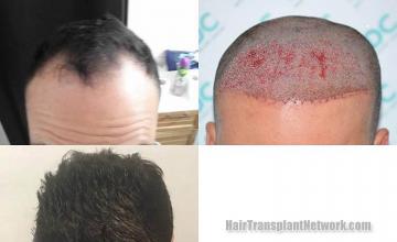 Front view - Before and after hair restoration procedure