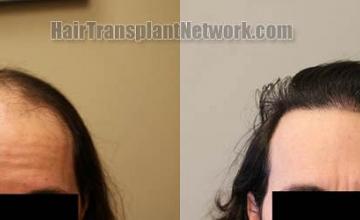 Before and after hair restoration procedure images