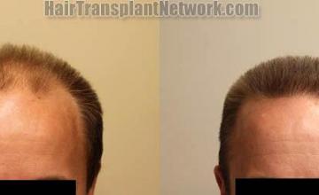 Front view - Before and after hair restoration procedure