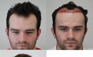 Front view - Before and after hair restoration procedure