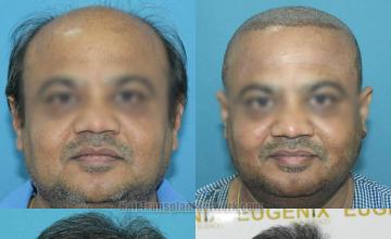 Front view - Before and after hair restoration procedure