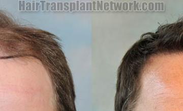 Front view - Before and after hair restoration procedure