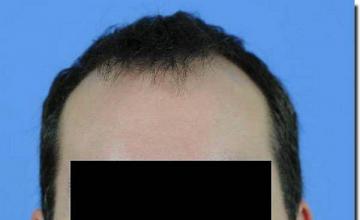 Hair restoration procedure results