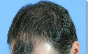 Hair restoration procedure results