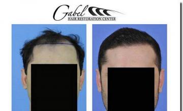 Hair restoration procedure results