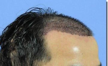 Hair restoration procedure results